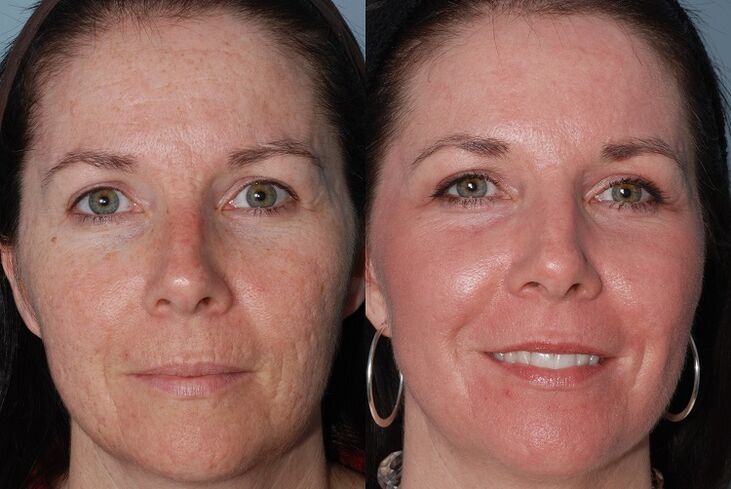 antes y después del rejuvenecimiento de la piel material