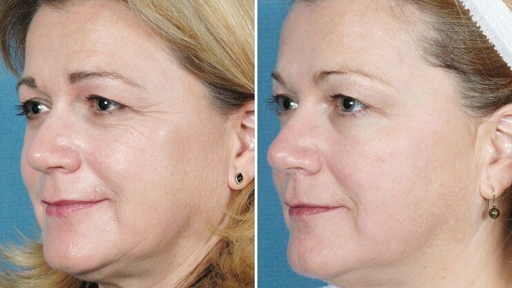 fotos antes y después del rejuvenecimiento de la piel material
