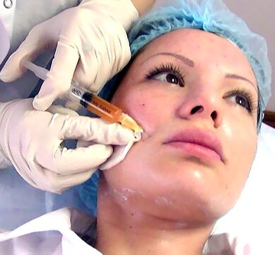 tratamiento de rejuvenecimiento de la piel con plasma