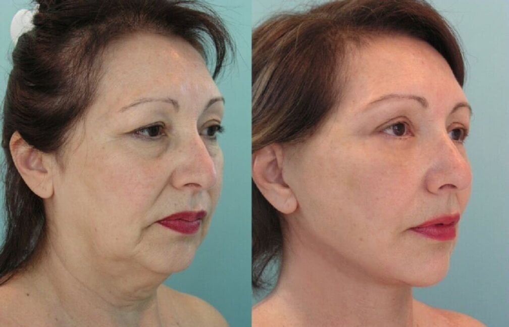 foto antes y despues del rejuvenecimiento de la piel
