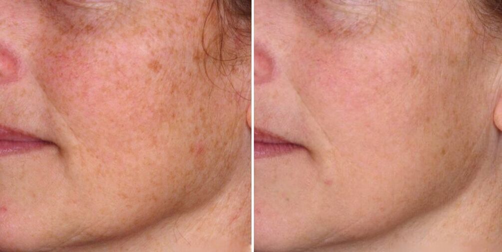 piel facial antes y después del rejuvenecimiento